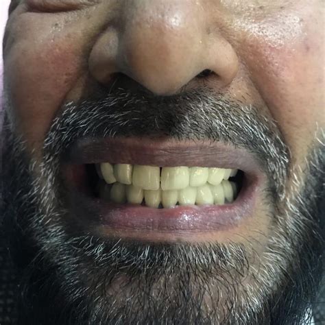 Full mouth bridge | Behzad Ali Khan | Prosthocontest2019