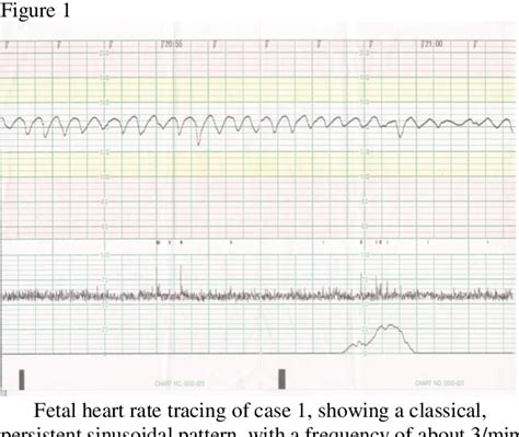 Figure 1 from Sinusoidal fetal heart rate pattern | Semantic Scholar