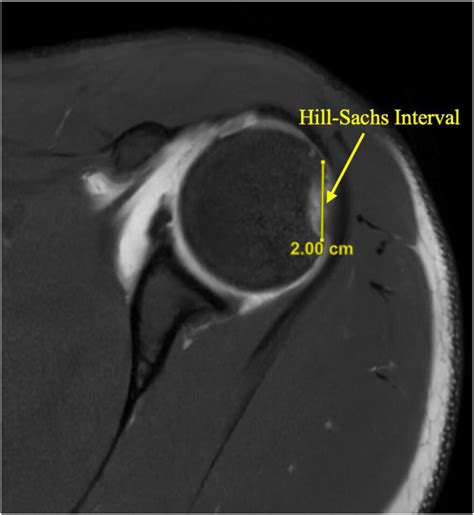 All-Arthroscopic Treatment of Off-Track Hill–Sachs Lesions Using Fresh ...