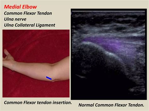 Presentation1.pptx, ultrasound examination of the elbow joint. | PPTX
