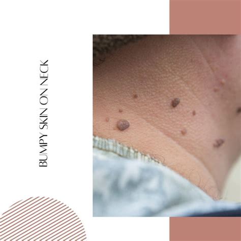 Skincare Routine for Rough and Bumpy Skin | Clinikally