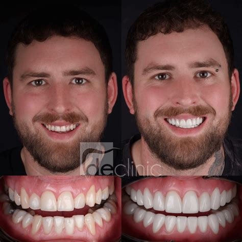 Top 97+ Pictures Pictures Of Front Teeth Crowns Superb