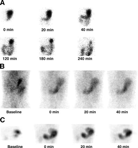 Alternative To Eggs For Gastric Emptying Study at Kim Delapaz blog