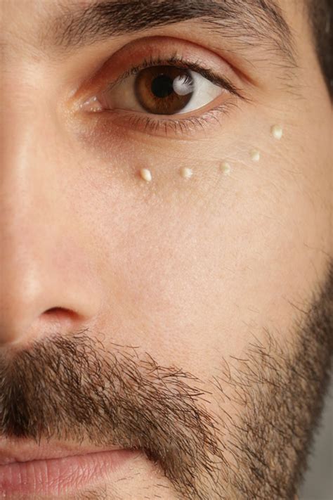 How To Get Rid Of Under-Eye Dark Circles In 5 Effective Ways
