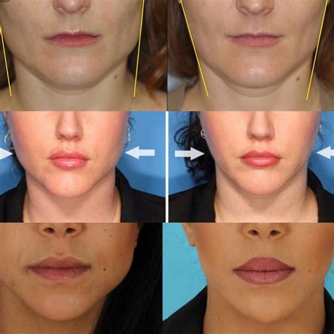 DR ARSH on Instagram: “Masseter Botox Treatment: 1. Jaw Sliming 2. Reduces Teeth Grinding and ...