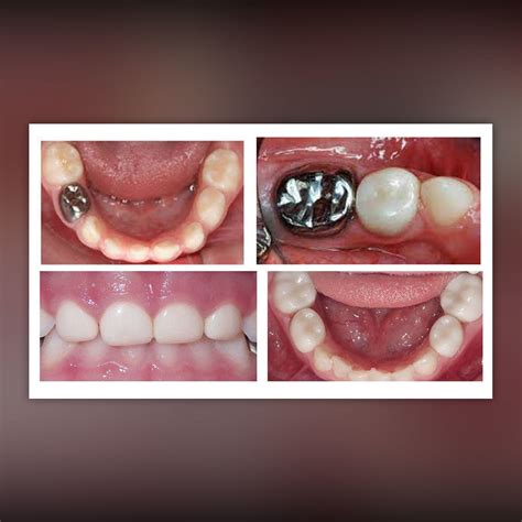 Restorative | Chelsea Pediatric Dentistry