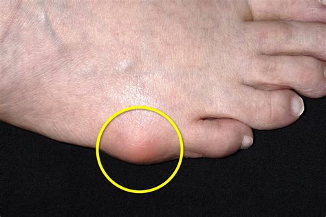 Bunion On Pinky Toe