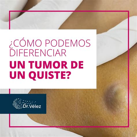 Diferencia Entre Quiste Y Tumor | Doctor Online