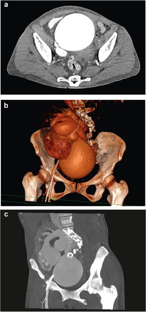 High-output cardiac failure from postbiopsy arteriovenous fistula - Kidney International