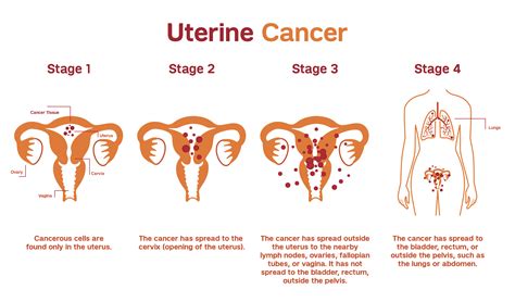 Endometrial and Uterine Cancers | Patient Care