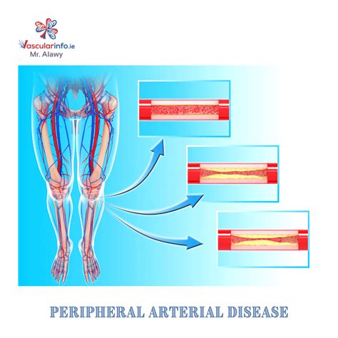 What Does Peripheral Vascular Disease Mean at Priscilla Scott blog