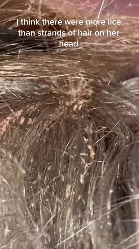 How To Get Rid Of Head Lice With Conditioner at Esther Corbett blog
