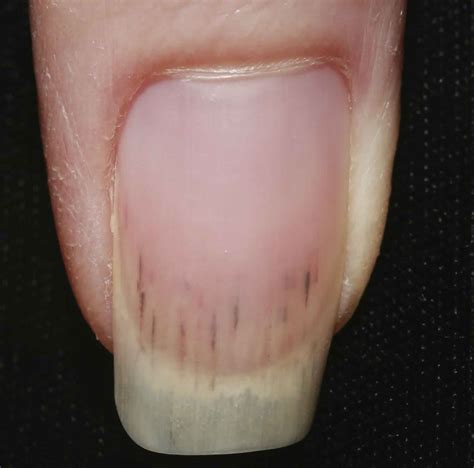 Osler nodes, Janeway lesions & splinter hemorrhages