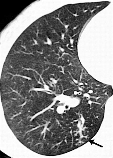 Tree-in-Bud Pattern at Thin-Section CT of the Lungs: Radiologic-Pathologic OverviewRadioGraphics