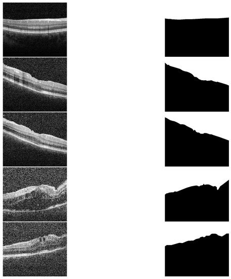 An Automated CAD System for Accurate Grading of Uveitis Using Optical ...