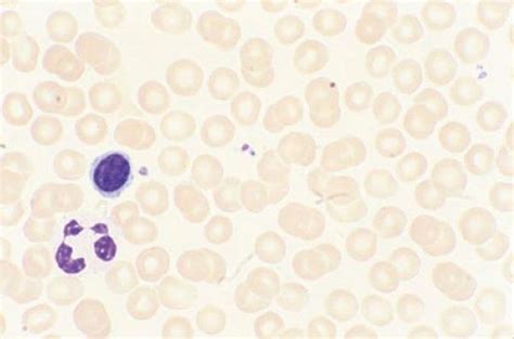 Image:Wright-Giemsa Stain of Peripheral Blood Smear-MSD Manual ...