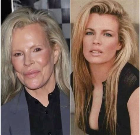 Kim Basinger Face Surgery