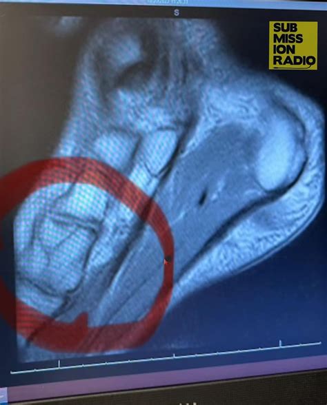 Colby Covington Reveals X-Ray Of His Broken Foot, Blaming It For His L ...