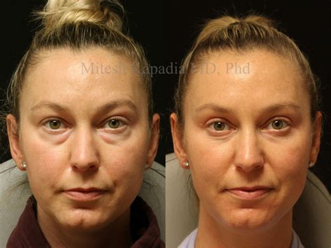 Before and six months after upper and lower blepharoplasty surgery | Boston Eyelid Surgery