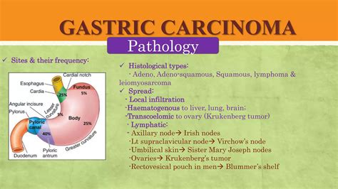 GASTRIC CARCINOMA- EPIGASTRIC LUMPS- Abdominal Lumps.pptx