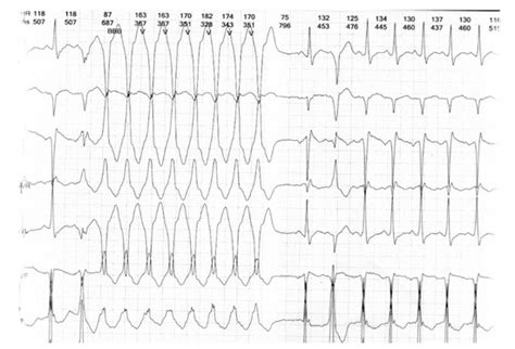 Heart Failure Post-SARS-CoV-2 Infection in Children with Duchenne ...