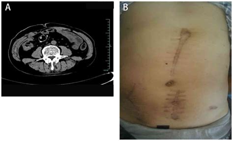 Fistula After Bowel Surgery