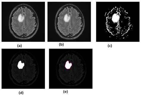 A Novel Brain Tumor Detection and Coloring Technique from 2D MRI Images