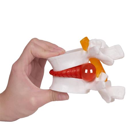 NLShan Human Anatomical Lumbar Disc Herniation Model, India | Ubuy
