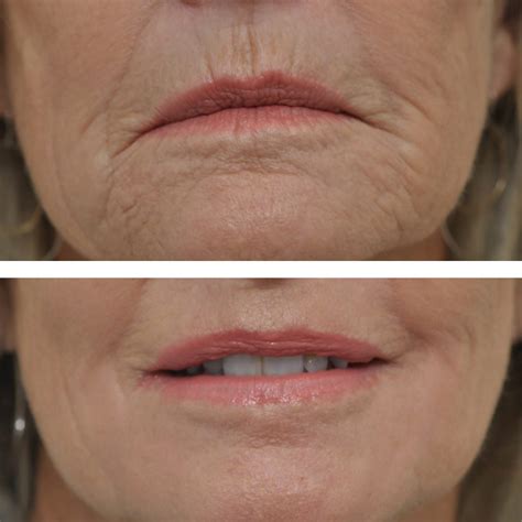 Deep Chemical Peel Jackson, MS | Faces, PLLC