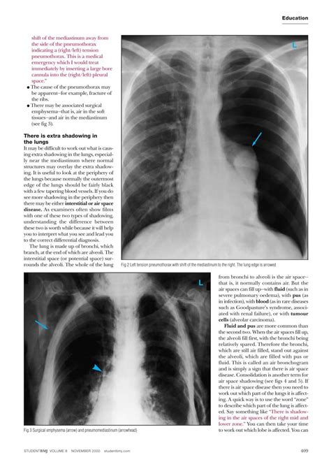 shift of the mediastinum