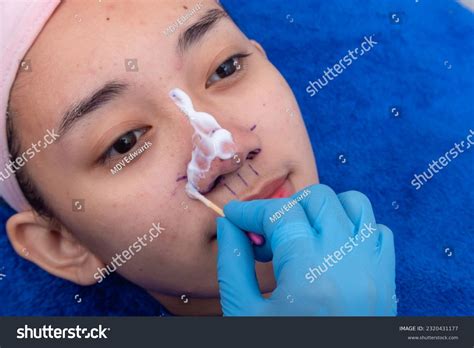 Surface Anesthesia 的图像结果