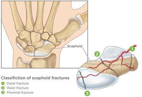 Scaphoid fracture causes, symptoms, diagnosis, treatment & revovery time