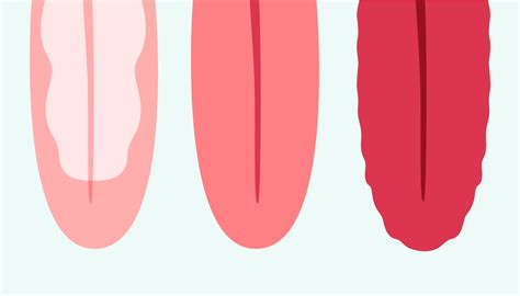 Normal Tongue Color Tongue Pathology Geographic Tongue, Fissured