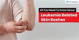 All you need to know about: Cancer skin rash and leukemia - MrMed