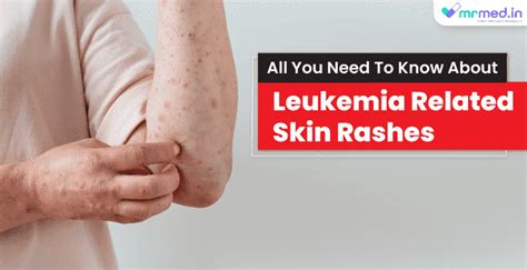 All you need to know about: Cancer skin rash and leukemia - MrMed
