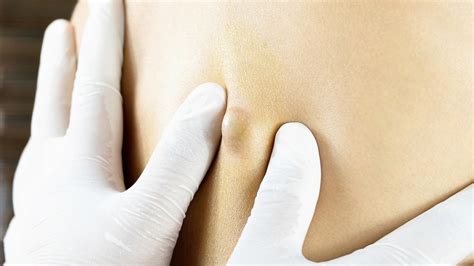 Dr. Pimple Popper Pops a 50-Year-Old Cyst in This Gruesome Video | Allure
