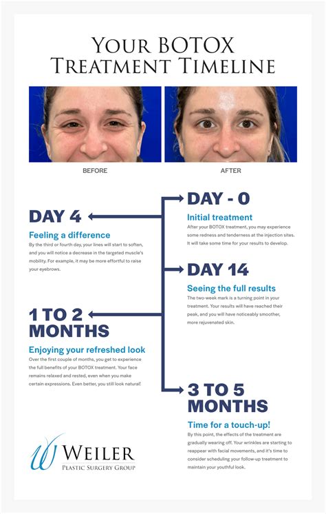 How Long Does BOTOX® Last? – Weiler Plastic Surgery Group