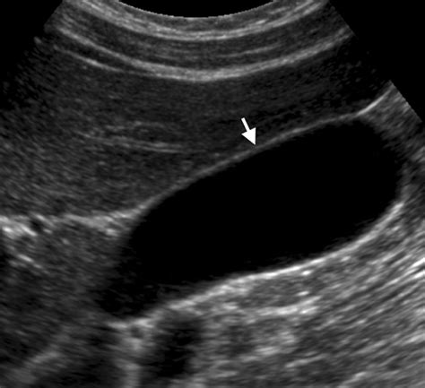 Diffuse Gallbladder Wall Thickening: Differential Diagnosis | AJR