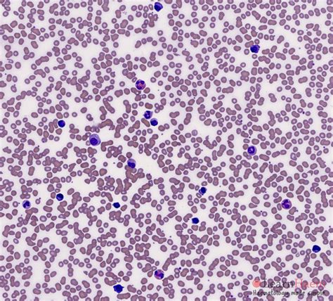 Plasma Cell Leukaemia - LearnHaem | Haematology Made Simple