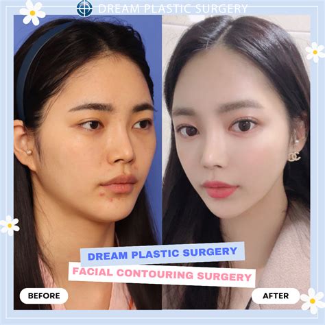 Plastic Surgery Before and After [Dream Plastic Surgery Korea] Asian Rhinoplasty + Facial Contouring