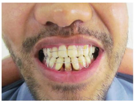 Mandibular Symphyseal/Parasymphyseal Fracture with Incisor Tooth Loss ...