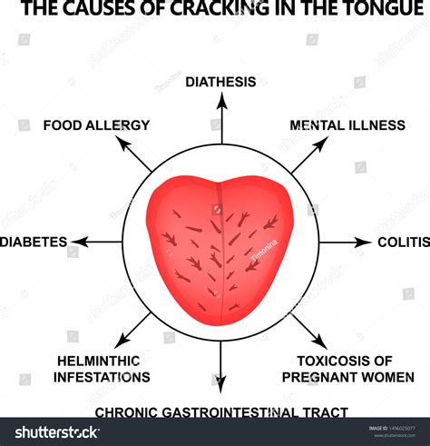 Causes Cracking Tongue Definition Disease According: Vector có sẵn (miễn phí bản quyền ...