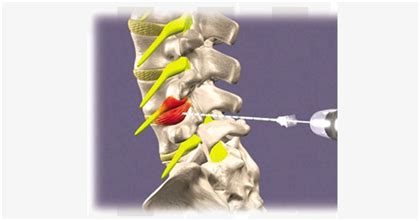 Image result for Disc FX Procedure