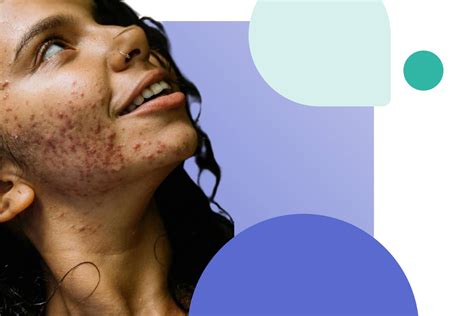 Online prescription for Accutane (Isotretinoin) by a Dermatologist