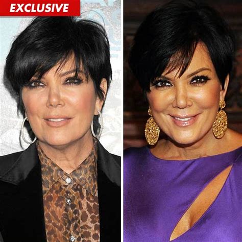 Kris Kardashian Facelift