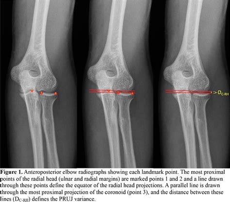 Evaluation of the Proximal Radio-Ulnar Joint Anatomy as a Marker for ...