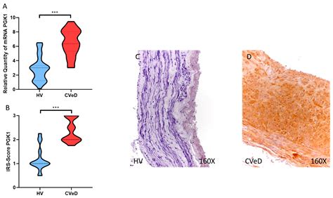 Venous Wall of Patients with Chronic Venous Disease Exhibits a ...
