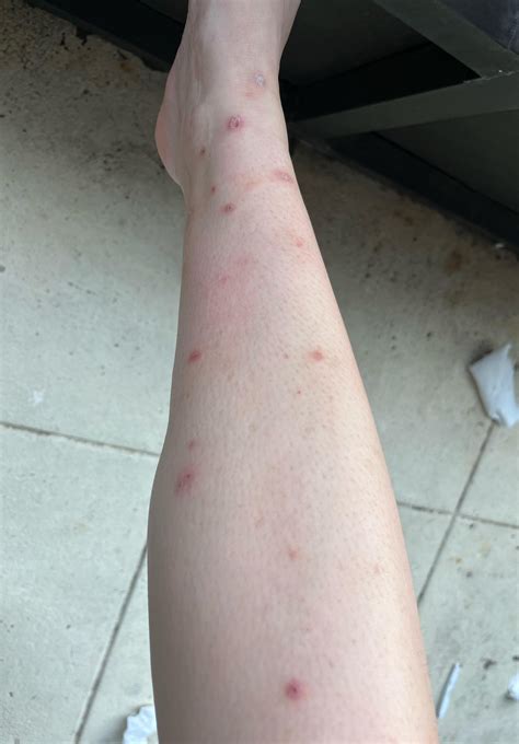 Sores On Legs