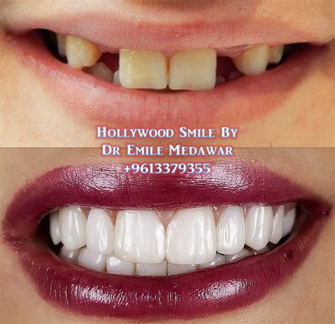 Dental Implants Lebanon | Emax Veneers Lebanon