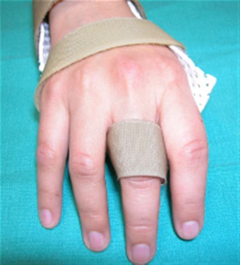 Sagittal Band Rupture - Hand - Orthobullets